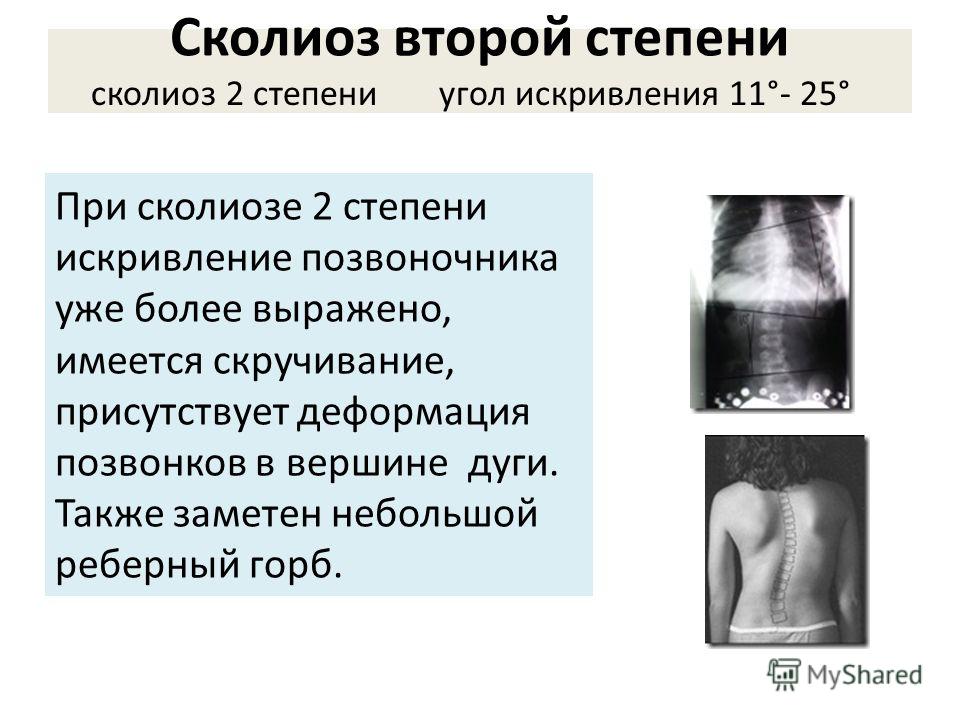 Сколиоз 2 степени лечение в домашних условиях отзывы