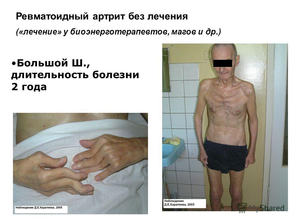 Как снять отек после снятия гипса когда спадёт отёк Как лечить ушиб голеностопного сустава?