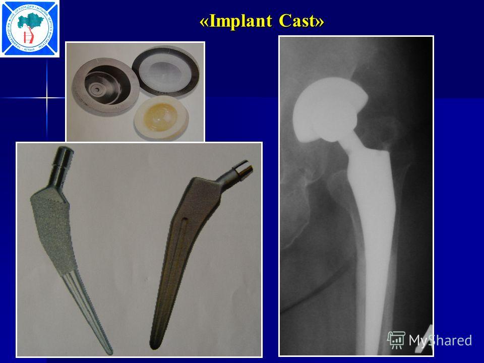 «Implant Cast» «Implant Cast»
