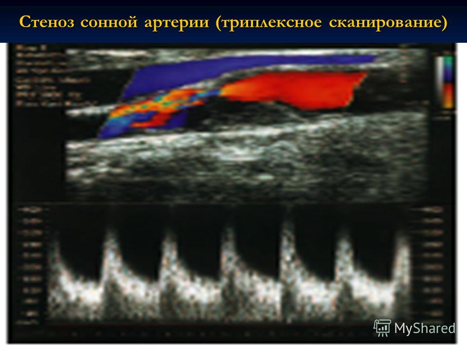 Стеноз сонной артерии (триплексное сканирование)