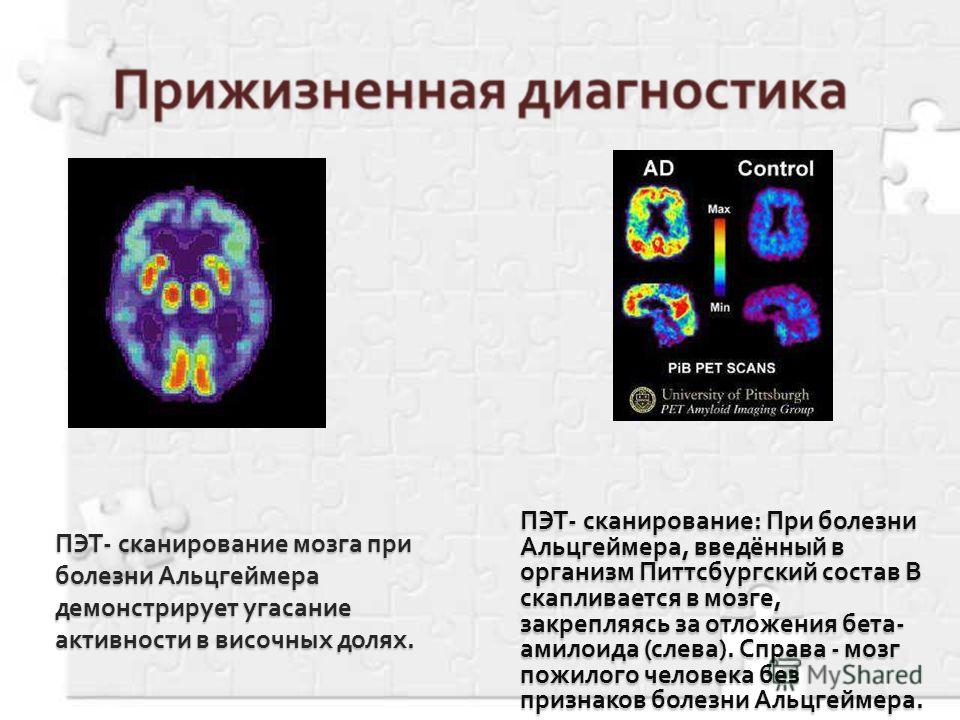 ПЭТ- сканирование: При болезни Альцгеймера, введённый в организм Питтсбургский состав B скапливается в мозге, закрепляясь за отложения бета- амилоида (слева). Справа - мозг пожилого человека без признаков болезни Альцгеймера.