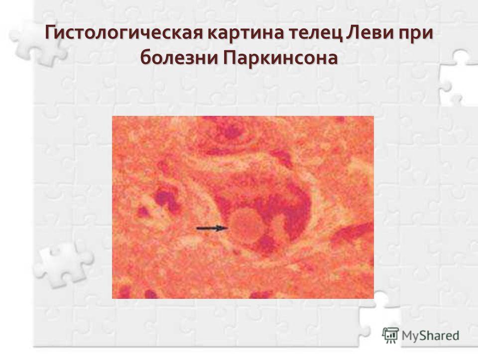 Гистологическая картина телец Леви при болезни Паркинсона