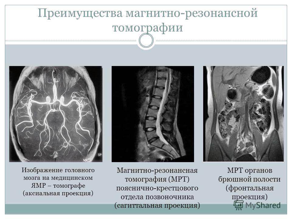 Преимущества магнитно-резонансной томографии Изображение головного мозга на медицинском ЯМР – томографе (аксиальная проекция) Магнитно-резонансная томография (МРТ) пояснично-крестцового отдела позвоночника (сагиттальная проекция) МРТ органов брюшной 