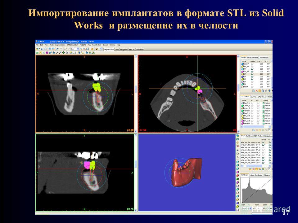 Импортирование имплантатов в формате STL из Solid Works и размещение их в челюсти 17