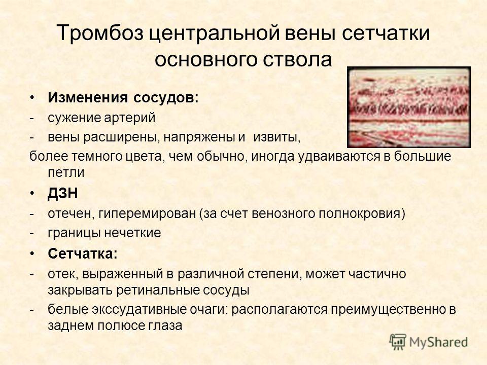 Реабилитация после удаления вены на ноге при варикозе
