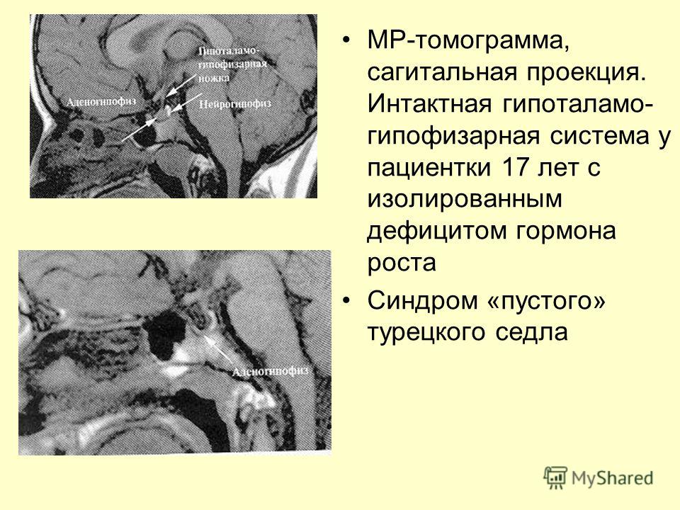 МР-томограмма, сагитальная проекция. Интактная гипоталамо- гипофизарная система у пациентки 17 лет с изолированным дефицитом гормона роста Синдром «пустого» турецкого седла