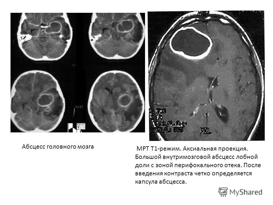 Абсцесс головного мозга МРТ Т1-режим. Аксиальная проекция. Большой внутримозговой абсцесс лобной доли с зоной перифокального отека. После введения контраста четко определяется капсула абсцесса.