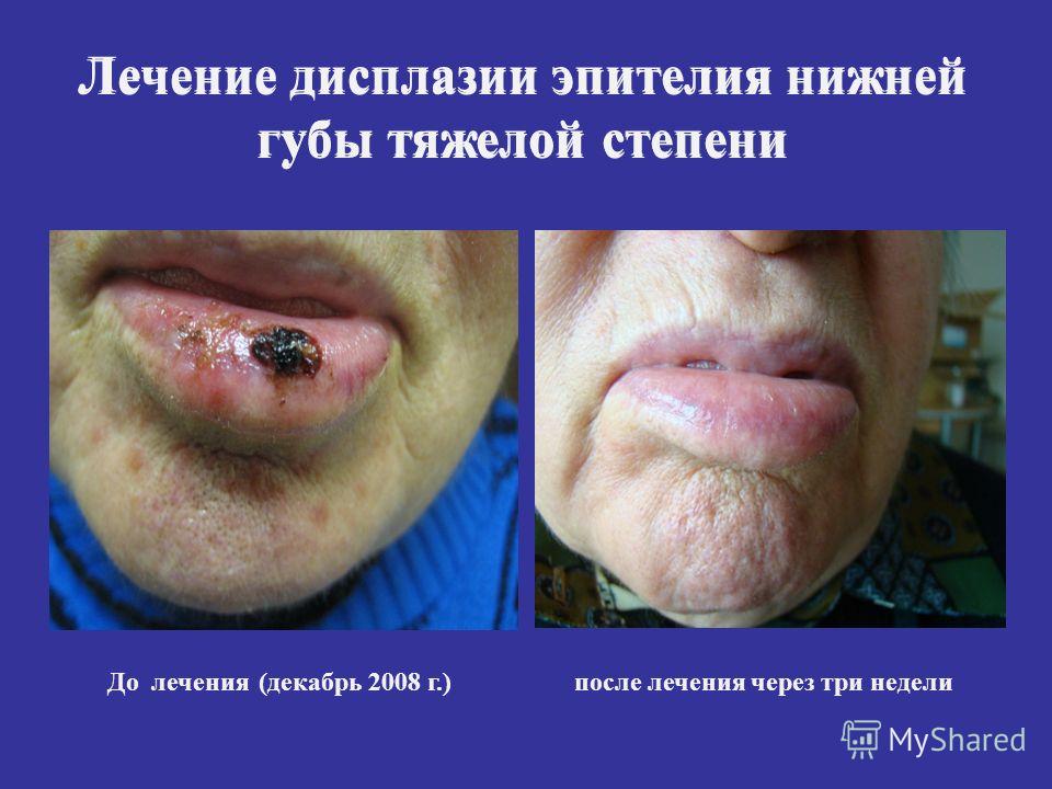 Лечение дисплазии эпителия нижней губы тяжелой степени До лечения(декабрь 2008 г.)после лечения через три недели Лечение дисплазии эпителия нижней губы тяжелой степени