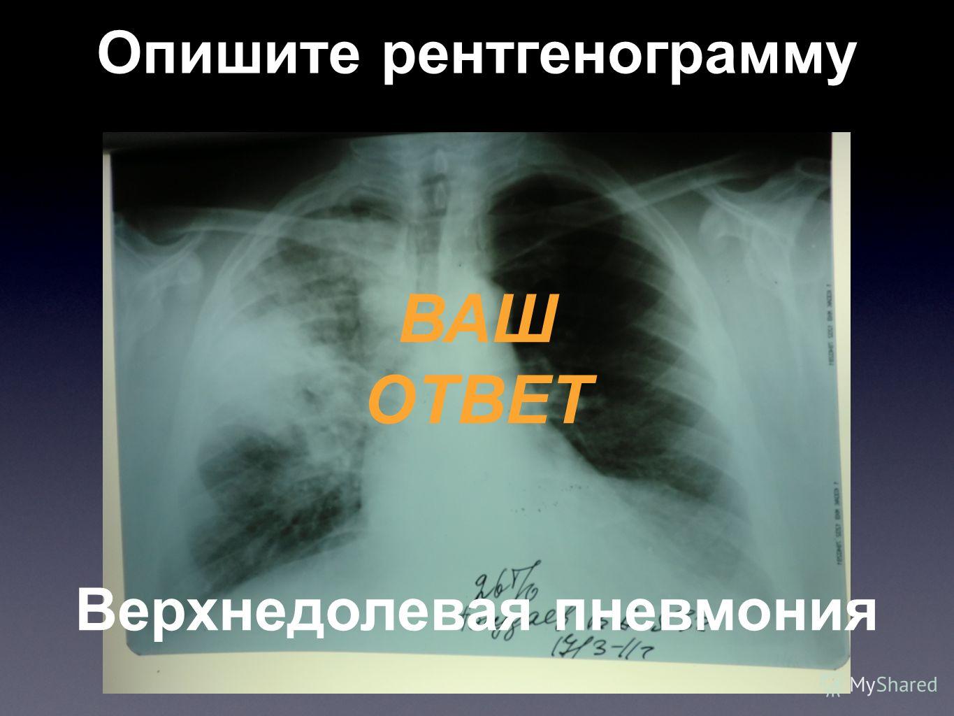 Опишите рентгенограмму ВАШ ОТВЕТ Верхнедолевая пневмония