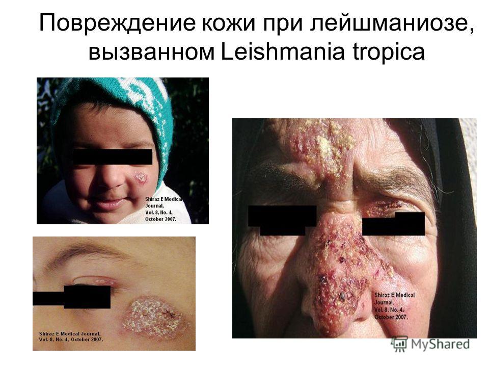 Повреждение кожи при лейшманиозе, вызванном Leishmania tropica