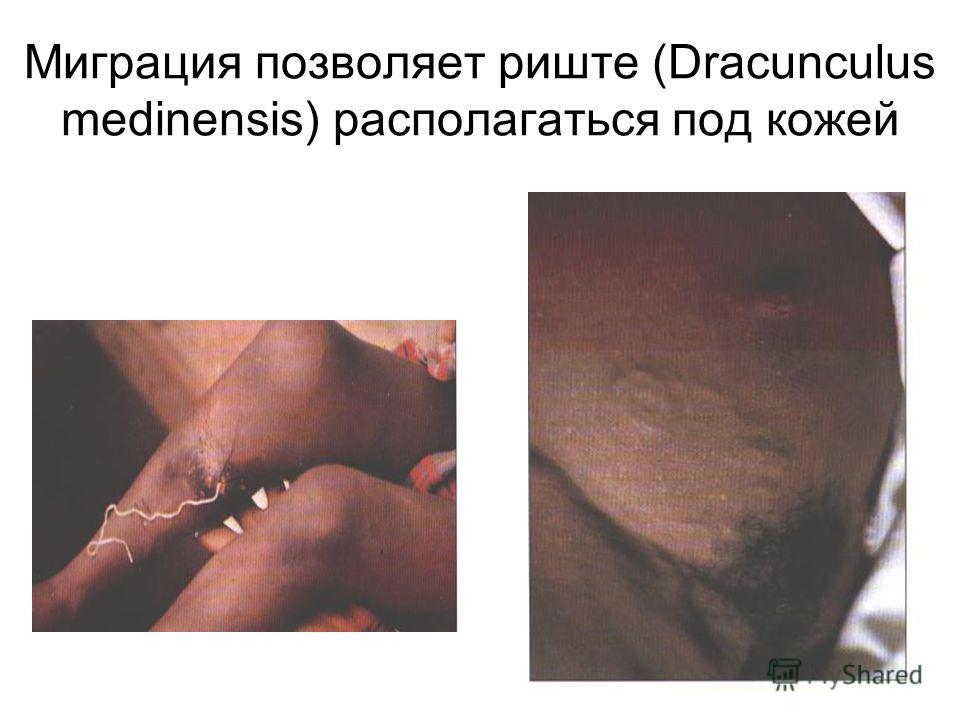 Миграция позволяет риште (Dracunculus medinensis) располагаться под кожей