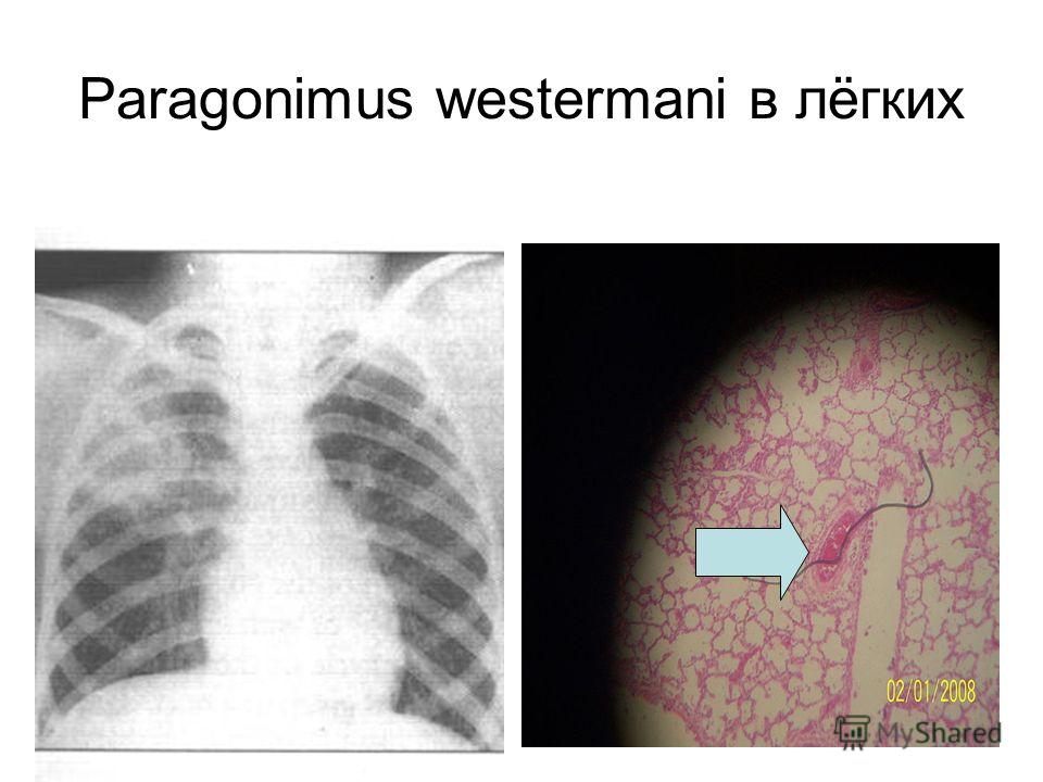 Paragonimus westermani в лёгких