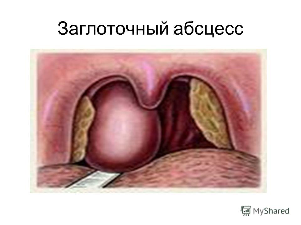 Как лечить артрит на пальцах рук препараты