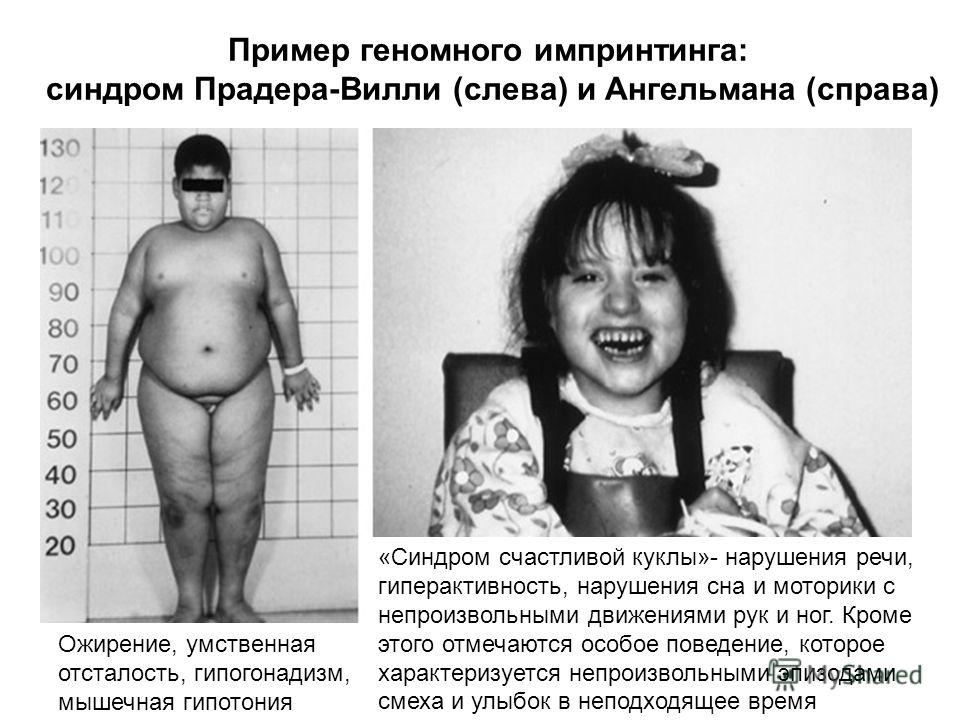 Пример геномного импринтинга: синдром Прадера-Вилли (слева) и Ангельмана (справа) Ожирение, умственная отсталость, гипогонадизм, мышечная гипотония «Синдром счастливой куклы»- нарушения речи, гиперактивность, нарушения сна и моторики с непроизвольным
