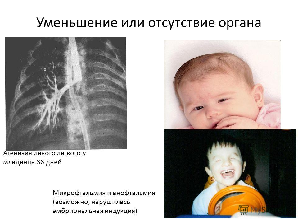 Уменьшение или отсутствие органа Агенезия левого легкого у младенца 36 дней Микрофтальмия и анофтальмия (возможно, нарушилась эмбриональная индукция)