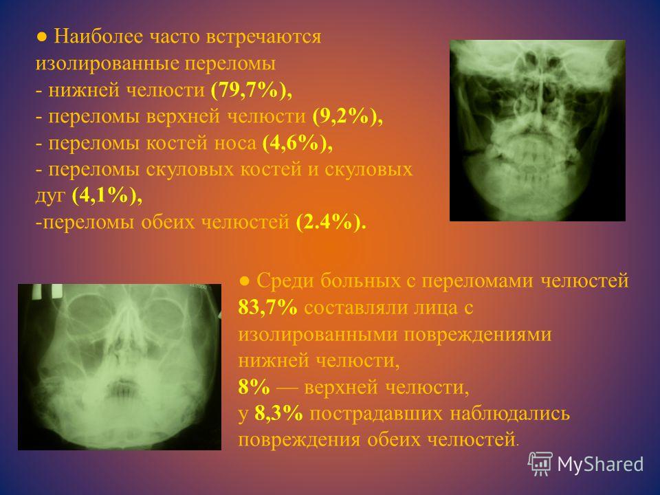 Наиболее часто встречаются изолированные переломы - нижней челюсти (79,7%), - переломы верхней челюсти (9,2%), - переломы костей носа (4,6%), - переломы скуловых костей и скуловых дуг (4,1%), -переломы обеих челюстей (2.4%). Среди больных с переломам