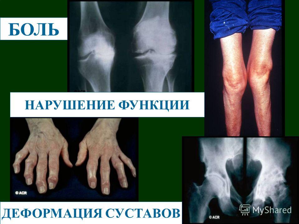 Лечение остеоартроза коленного сустава народными средствами. Остеоартроз коленного сустава 1 и 2 степени. Лечение деформирующего. Гонартроз коленного сустава 2 степени: терапия медикаментами и. Лечение деформирующего остеоартроза суставов ног лазером — аппараты ОРИОН.