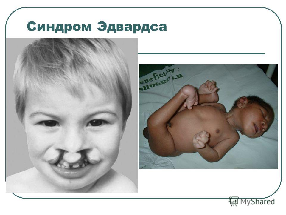 Синдром Патау Википедия 32 Синдром Патау Википедия 14