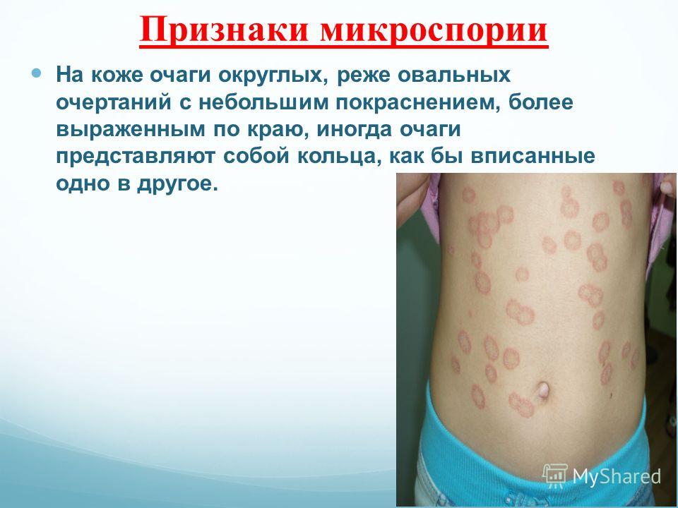 Заболевание кожи бедер Заболевание кожи бедер