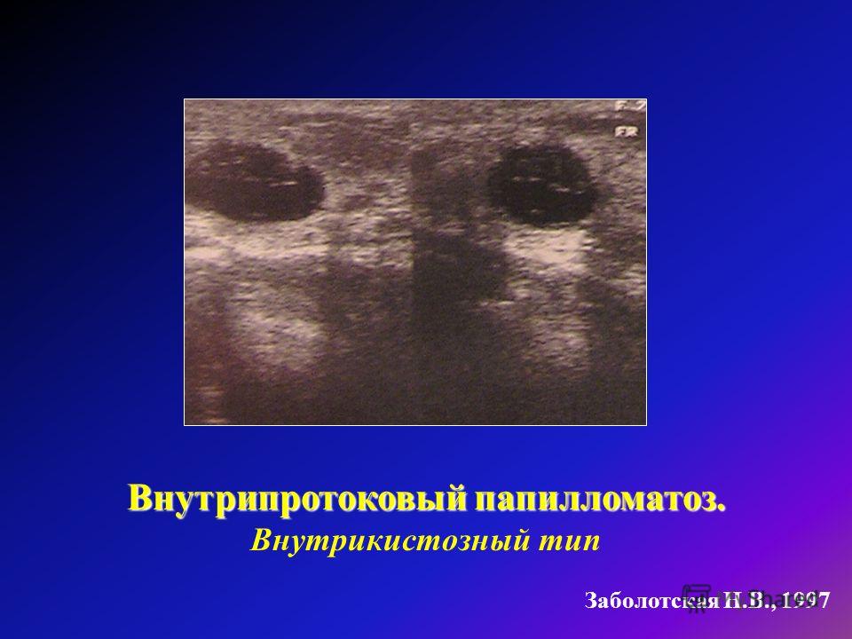 predlozhit zhelezi pri uzi vnutriprotokoviy papillomatoz molochnoy neplohoy Внутрипротоковый папилломатоз при узи молочной железы фото