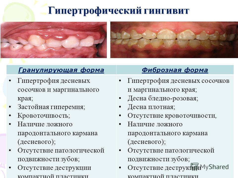 Воспаленные дёсна у ребенка Воспаленные дёсна у ребенка