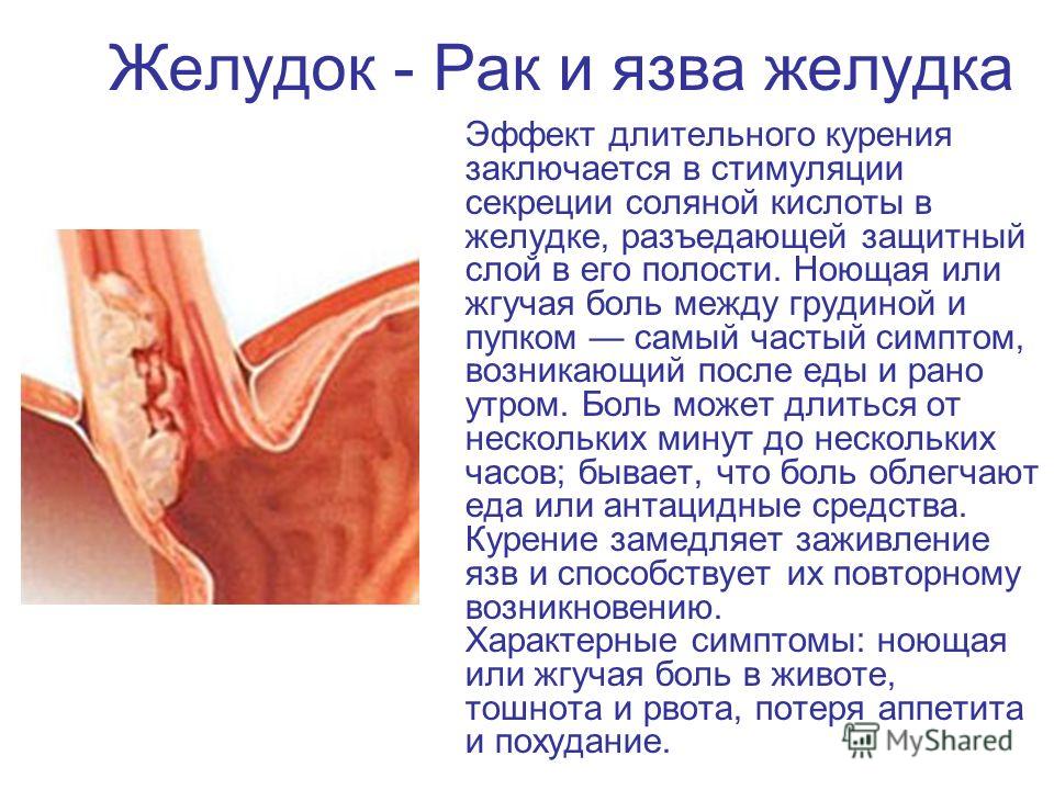 Как избавится от гастрита в домашних условиях 813 Как избавится от гастрита в домашних условиях 194