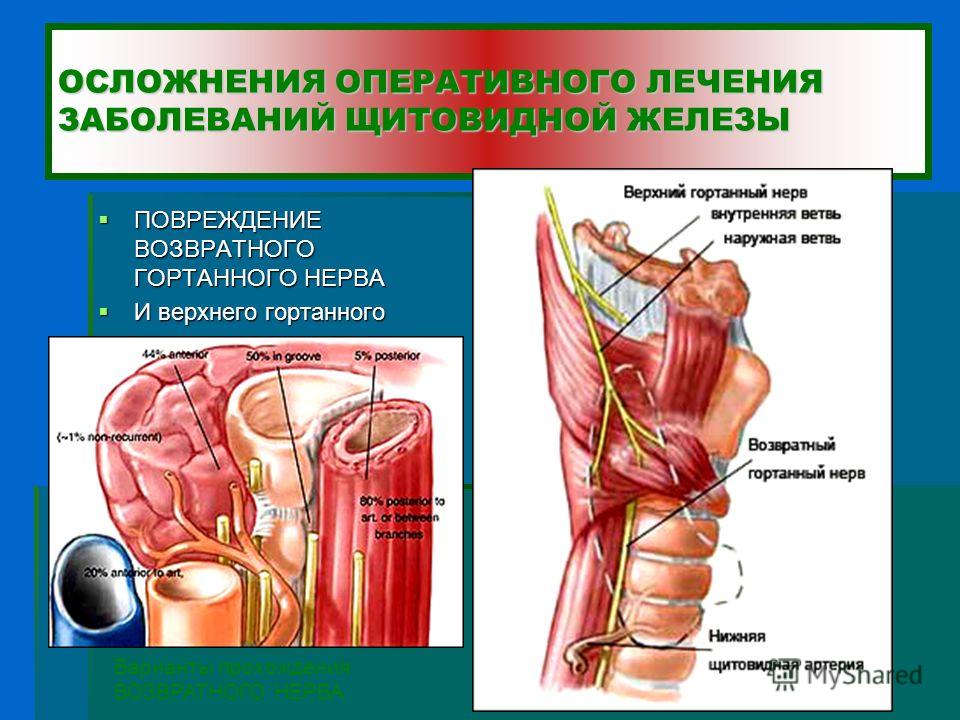 Как лечить невралгию верхнего гортанного нерва Как лечить невралгию верхнего гортанного нерва