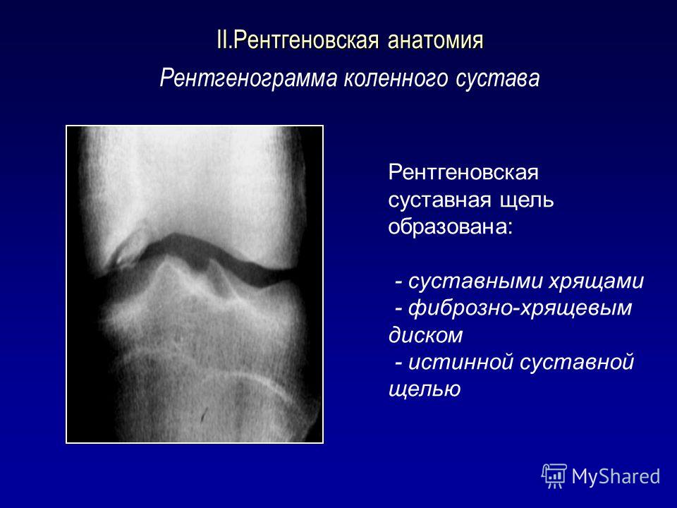 Трещина хряща коленного сустава Трещина хряща коленного сустава
