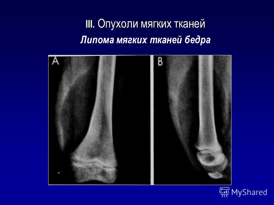 Туберкулез костных суставов Туберкулез костных суставов