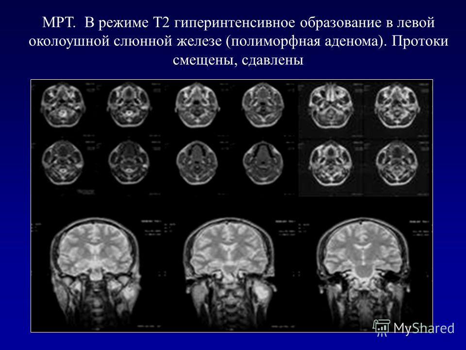 Диагностика аденомы слюнных желез Диагностика аденомы слюнных желез