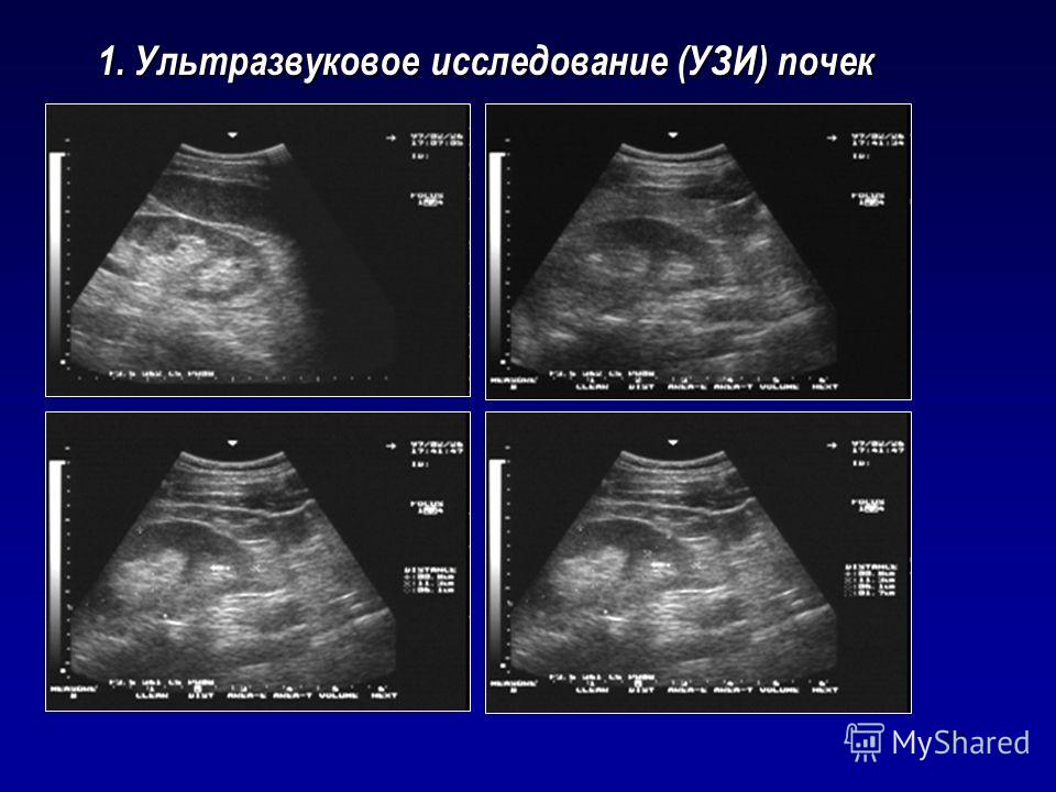 Как сделать узи почки Как сделать узи почки
