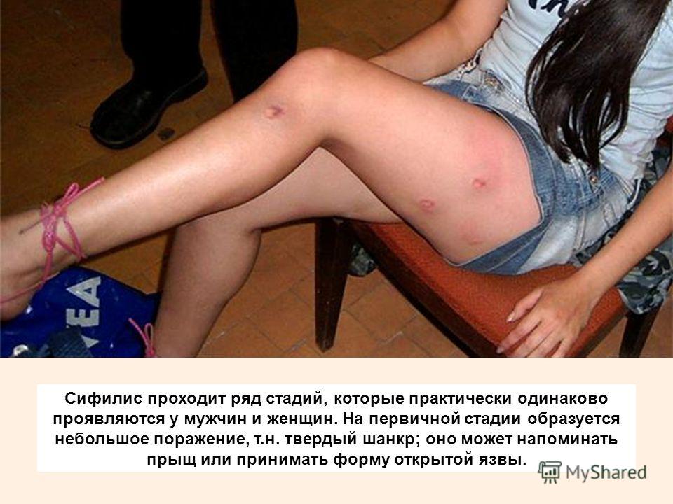 Часто ли проститутки болеют венерическими Часто Ли Проститутки Болеют Венерическими