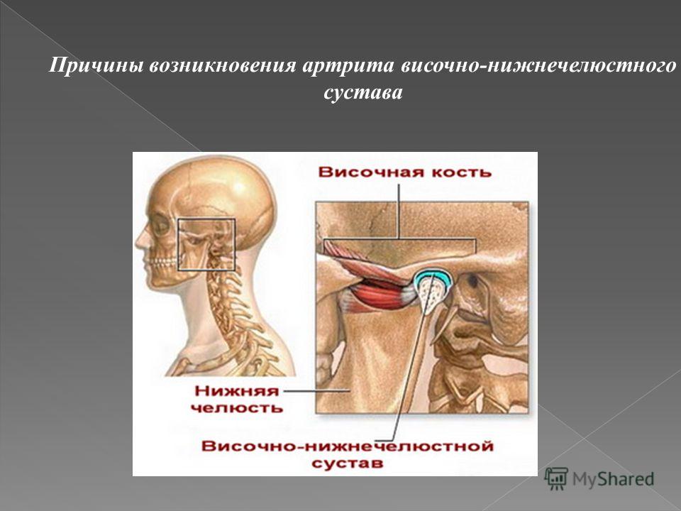 Дистрофические заболевания височно - нижнечелюстного сустава бег суставы