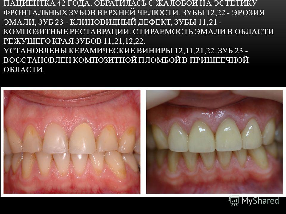 Повышенная стираемость зубов клиника Повышенная стираемость зубов клиника