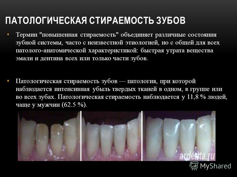 Патологическая стираемость зубов этиология клинические формы Патологическая стираемость зубов этиология клинические формы