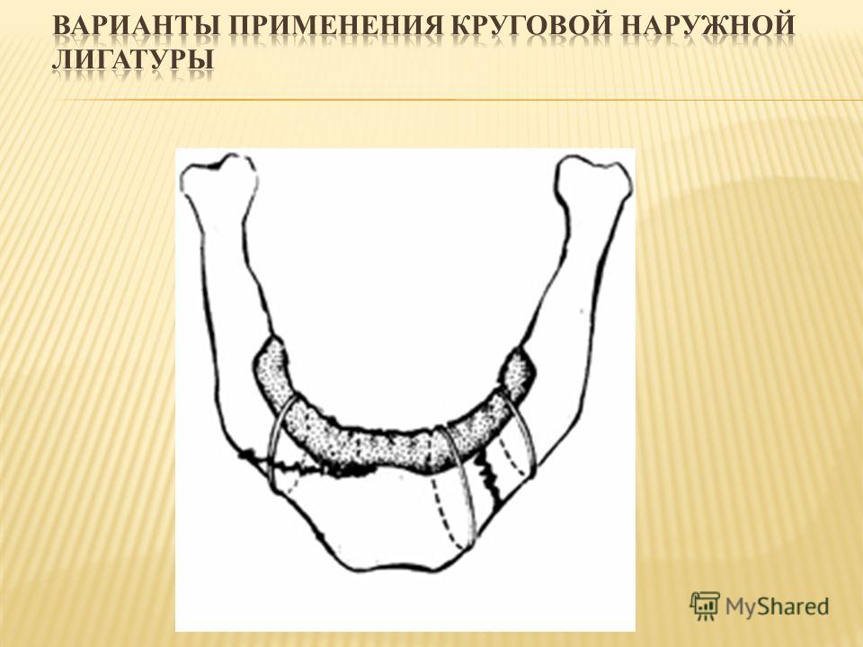 Методы обезболивания зубов у детей Методы обезболивания зубов у детей