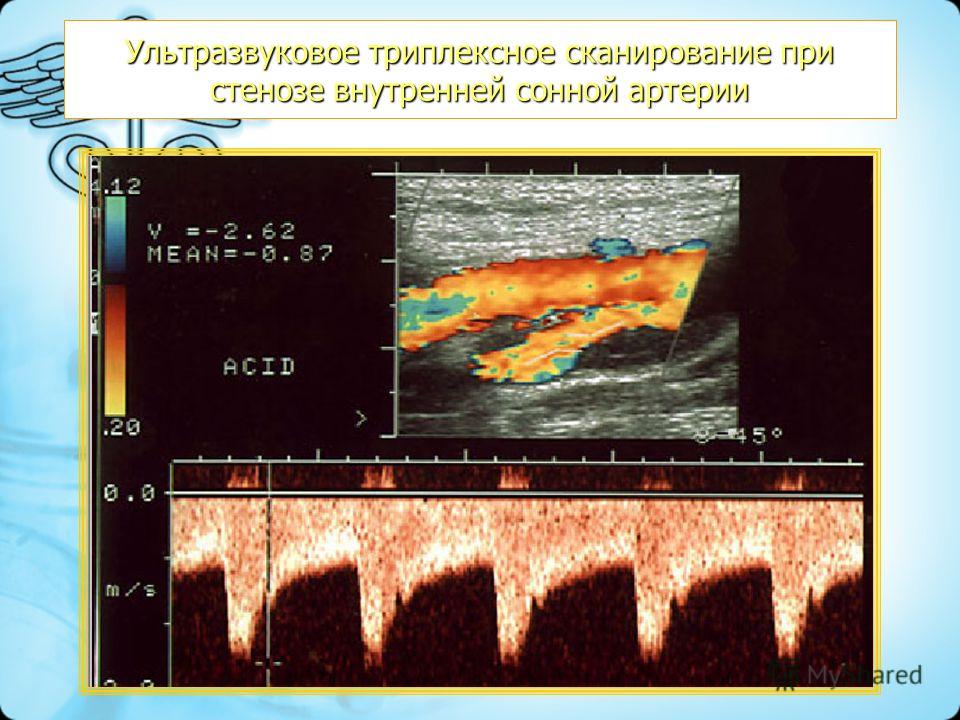 Ультразвуковое триплексное сканирование при стенозе внутренней сонной артерии