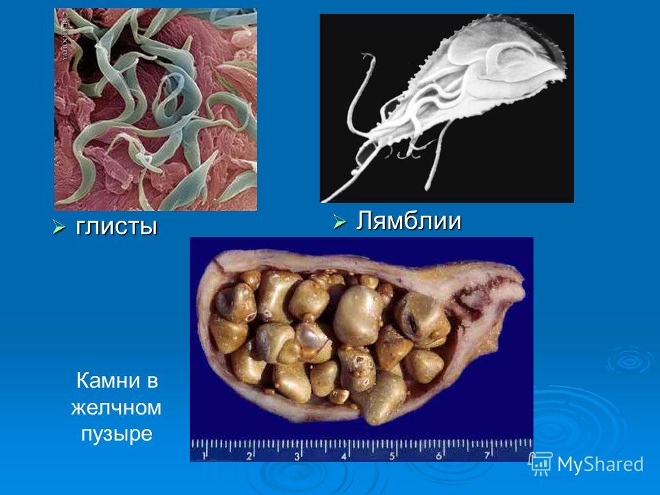 Как лечить у взрослого лямблии в печени 3