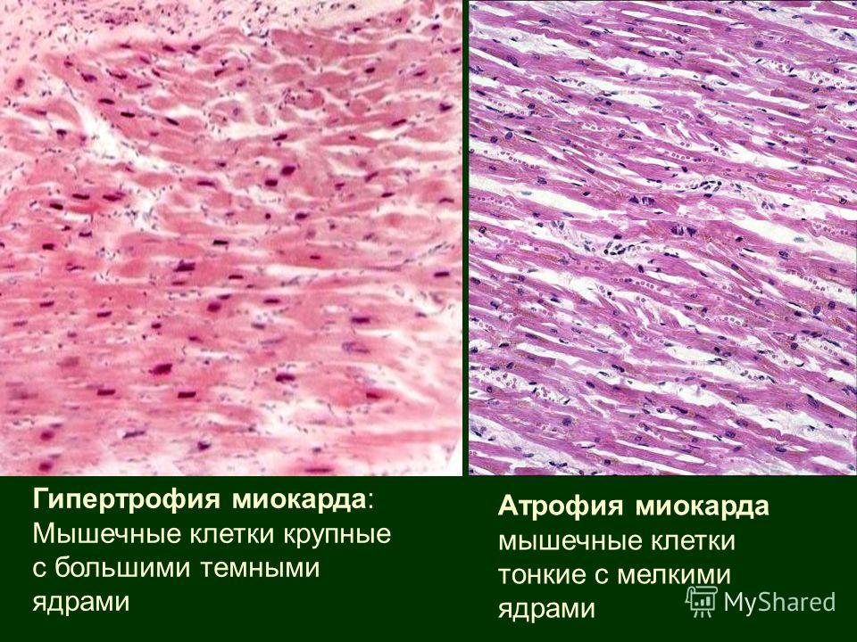 Гипертрофия мышц схемы Гипертрофия мышц схемы
