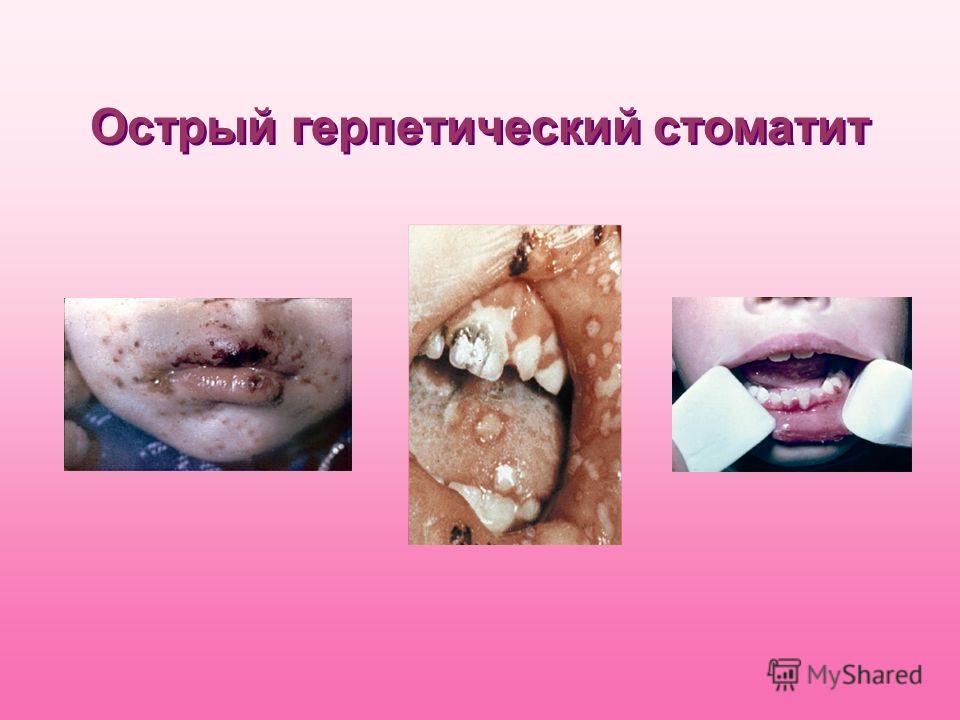 болезни слизистой оболочки полости рта презентация