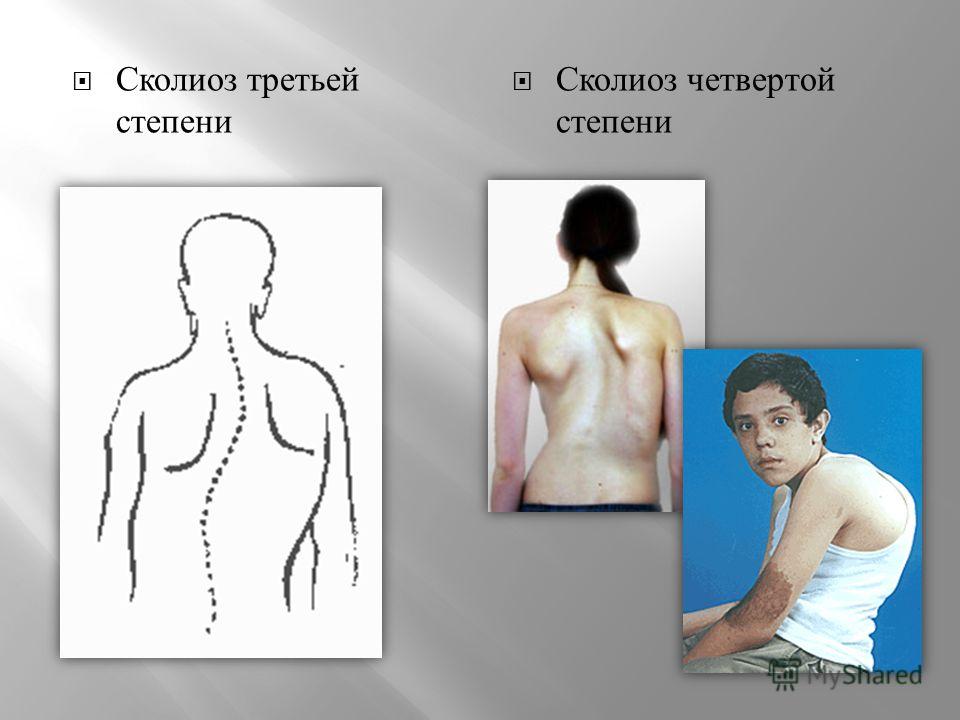 Как в домашних условиях проверить сколиоз 568