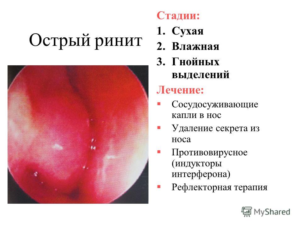 Как лечить острый насморк народными средствами Как лечить острый насморк народными средствами