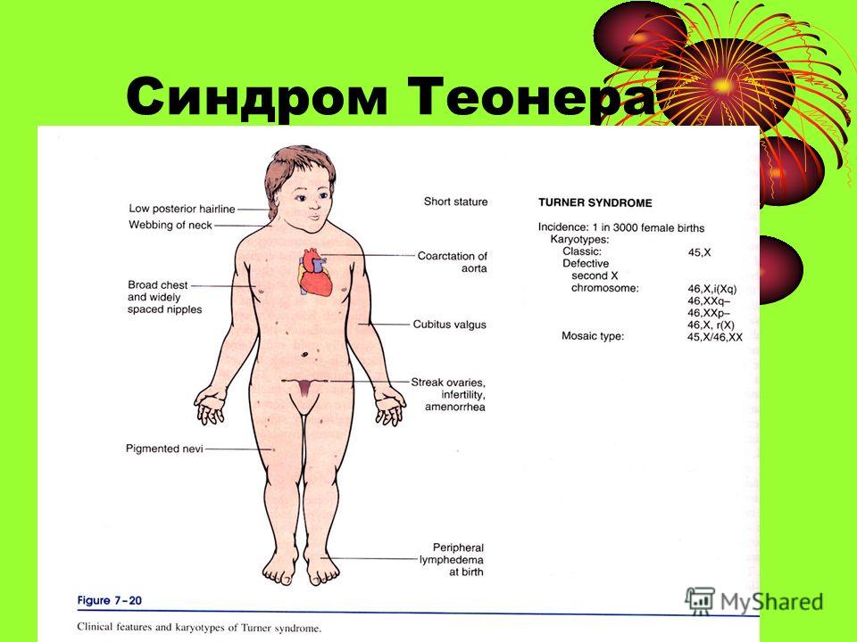 Боль в правой яичнике головные боли