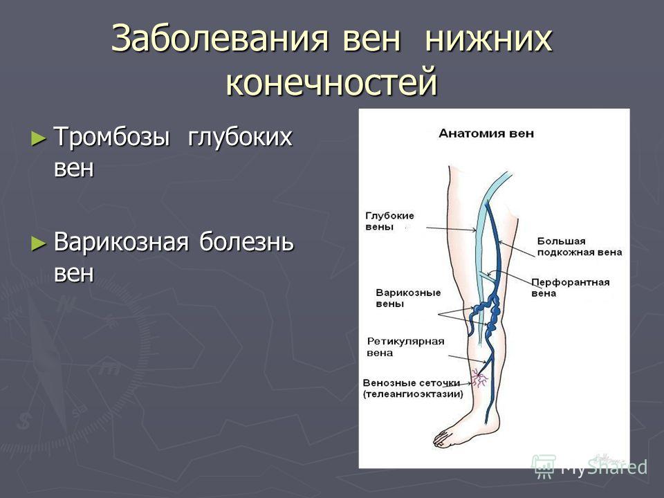 Варикозная Болезнь Вен Нижних Конечностей Лечение