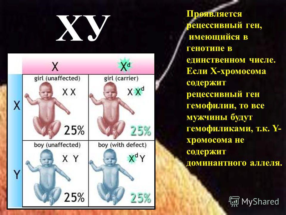 ХУ Проявляется рецессивный ген, имеющийся в генотипе в единственном числе. Если Х-хромосома содержит рецессивный ген гемофилии, то все мужчины будут гемофиликами, т.к. Y- хромосома не содержит доминантного аллеля.