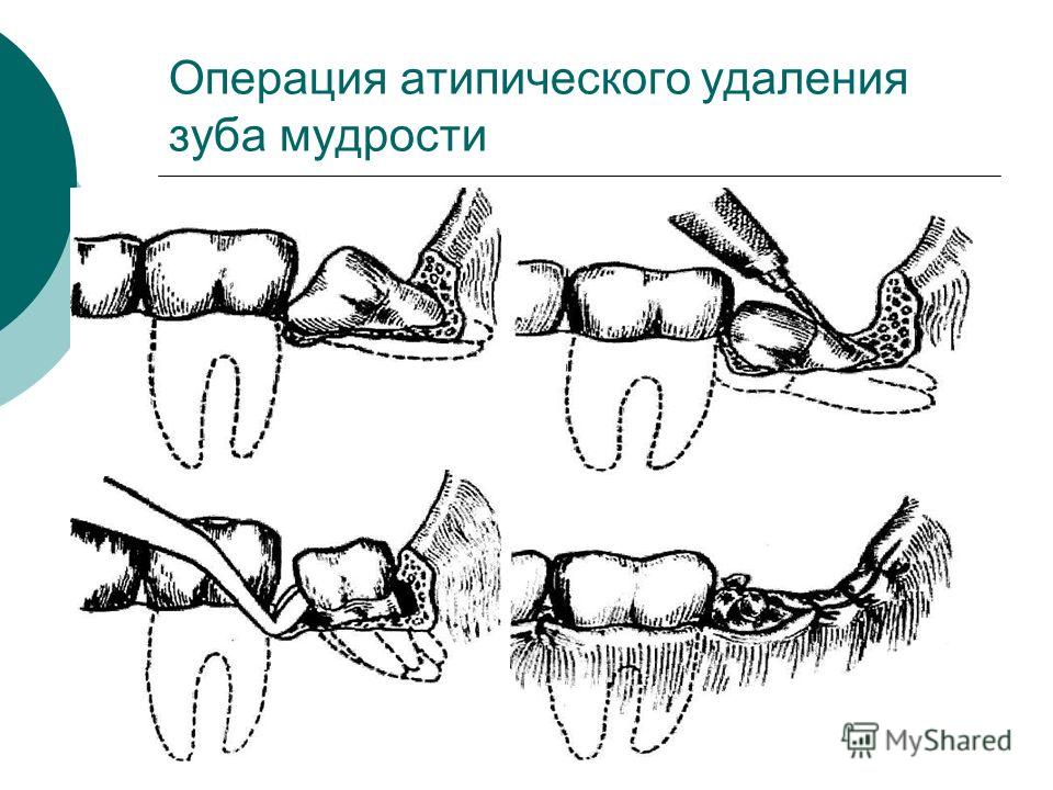 Операция по удаленью мудрого зуба Операция по удаленью мудрого зуба