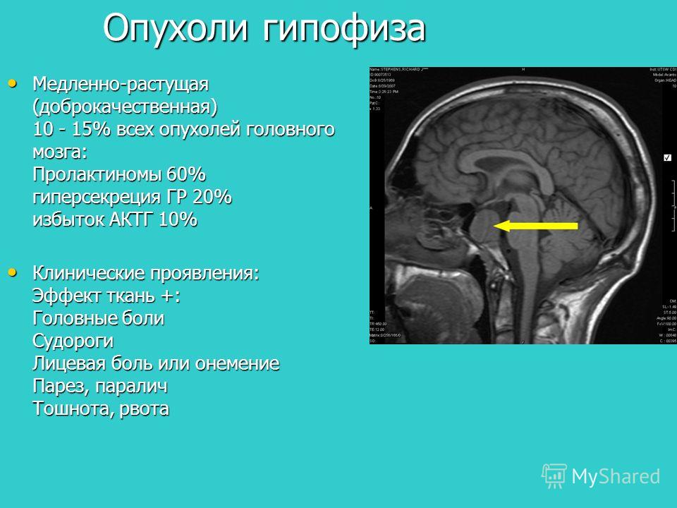 Гипертоническая болезнь - народный способ вылечиться от нее Все мифы о питании после удаления рака простаты