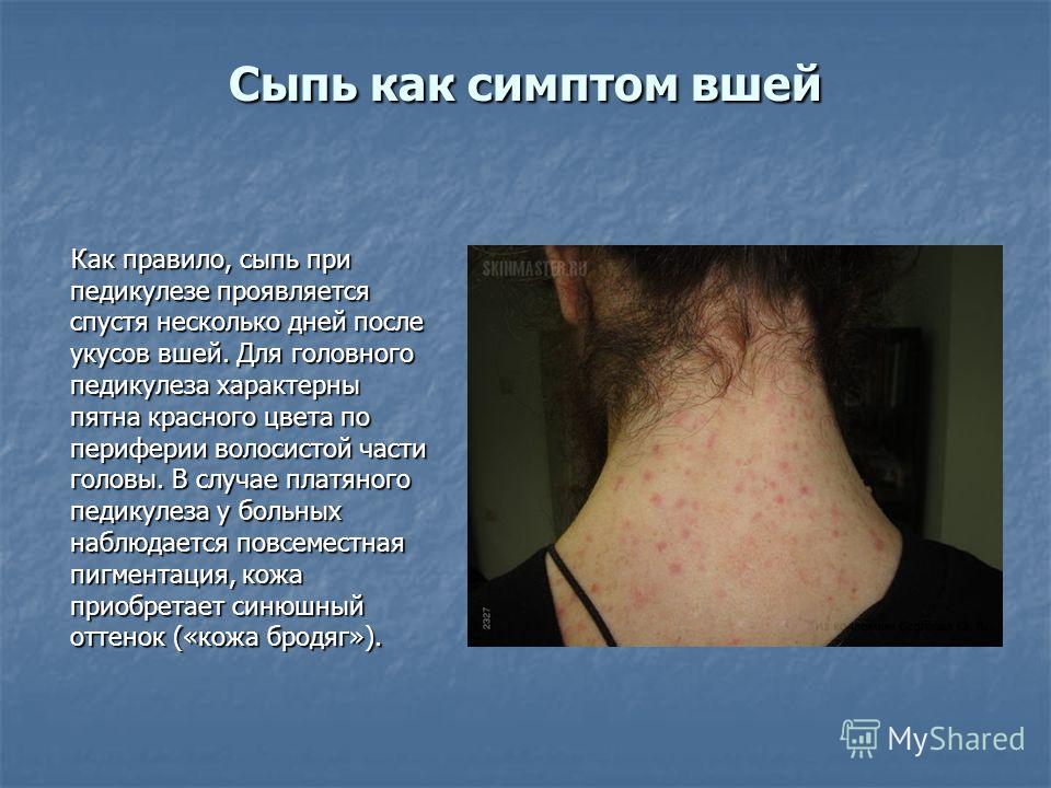 Кожа головы при педикулезе Кожа головы при педикулезе