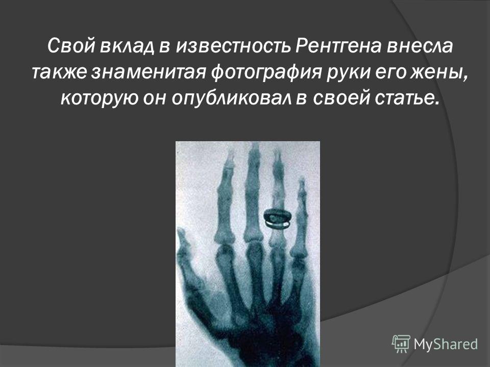 Свой вклад в известность Рентгена внесла также знаменитая фотография руки его жены, которую он опубликовал в своей статье.