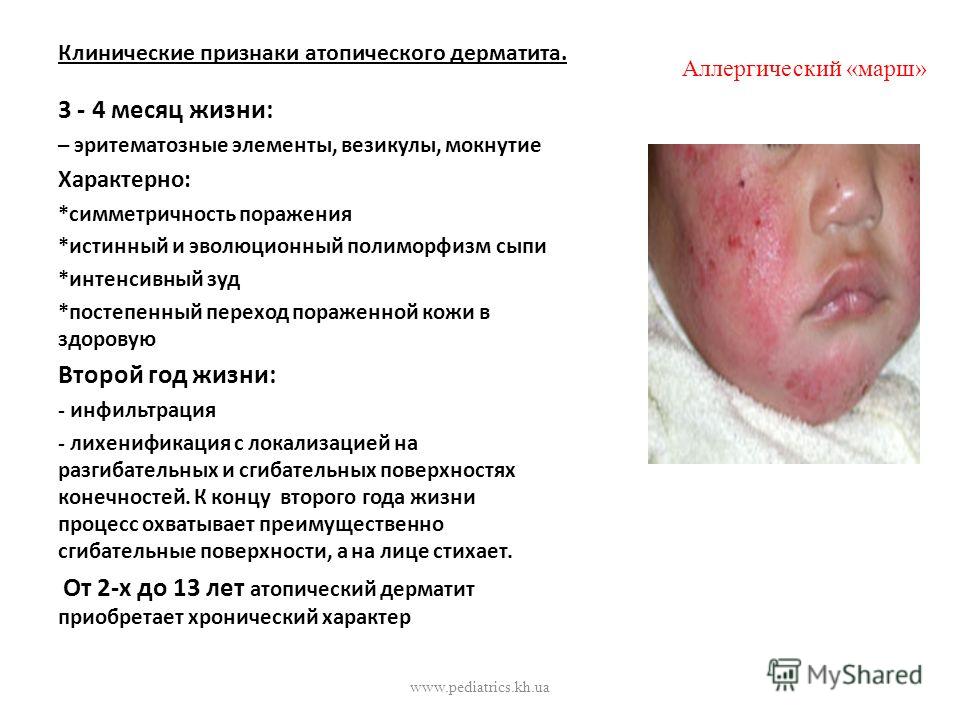 Как лечить атопический дерматит у ребенка 1 год Как лечить атопический дерматит у ребенка 1 год